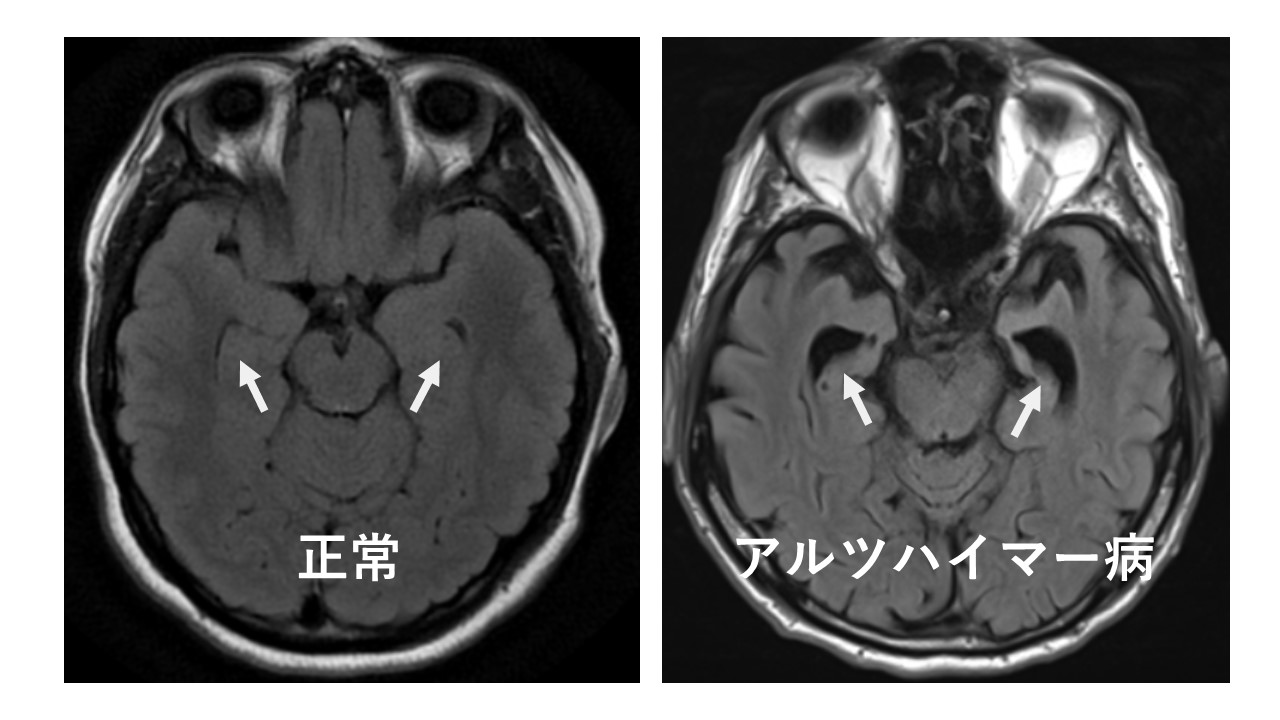 アルツハイマー病での海馬の萎縮