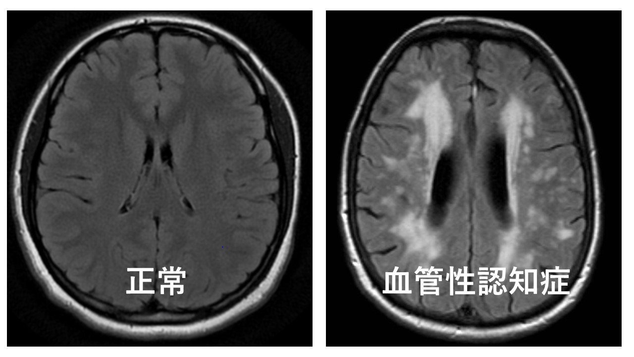 MRIによる血管性認知症の診断